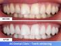Best Teeth Whitening Treatment in Andheri, Mumbai Best Teeth Whitening Treatment in Andheri, Mumbai