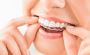 Perfecting Smiles: Invisalign Retainer Services in Evansvill