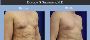 Male Breast Reduction in Los Angeles