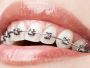 How Much Does Metal Braces Cost?