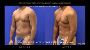 Sculpt Your Body with Liposuction for Men in New York