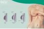 Breast Lift and Reduction Surgery in Bangalore - Anew Aesthe