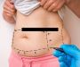 Hasan Surgery | Best Liposuction Clinic in Dubai