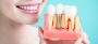 Get Dental Crowns and Bridges from Arenson Dental