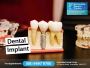 Dental Implants Armadale WA 6112 - Armadale Dental Centre