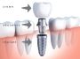 Dental Implant Cost In Gurgaon India : Dr. Ravneet Kaur
