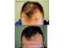 Treat hair loss in Adelaide using quality natural products