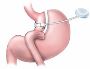 Contact for Best Lap Gastric Band in Charleston, WV