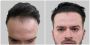 Trusted Clinic for Hair Transplant in Gurgaon - Satya Hair S