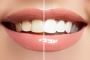 Teeth Whitening Eastern Suburbs