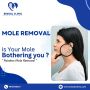 Revitalize Your Skin: Moles Pigmentation Treatment at Bindal
