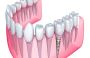Dental Implants In Valdosta, GA | Restoring Your Perfect Smi