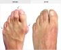 5 Steps To Do Foot Bunion Treatment 