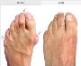 4 points: how do you get rid of foot bunions?