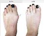 5 measure for foot bunion surgery