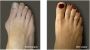 Minimally invasive bunion surgery - 5 Quick recovery tips