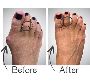 5 Quicker recovery way for keyhole bunion surgery 
