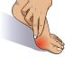5 tips of ease foot bunion treatment 