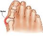 Can valgus hallux be treated without surgery?