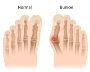 7 Step Guide for Treating Bunion Pain
