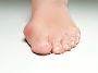 Foot Bunion / How to Get Relief 
