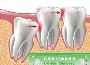 Is extraction of wisdom tooth painful?