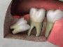 5 Dental procedure of extraction of wisdom tooth