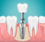 Restore Smiles with Dental Implants in Markham