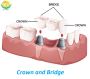 Looking for High-Quality Crowns and Bridges Made in China?