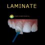 Transform Smiles with Non-Prep Veneers from China Transform Smiles with Non-Prep Veneers from China