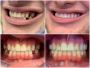 Same Day Dental Crowns Near Me Same Day Dental Crowns Near Me
