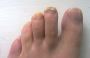 How To Wipe Out Nasty, Stubborn Foot Fungus!