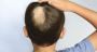 Coping up With Alopecia Tips from Hair Loss Treatment Perth