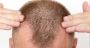 Signs of Androgenetic Alopecia from Hair Health Australia