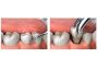About Orthodontix Dental Clinic Dubai UAE Teeth Extraction