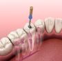 Get Expert Root Canal Surgery Treatment in Townsville