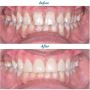 Smile Confidently with Dental Implant Surrey-done