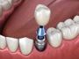Understanding Dental Implant Cost Surrey