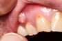 Signs Of Infection After Root Canal Treatment