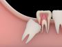 Find out if you Need Wisdom Teeth Removal Near Me