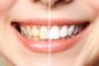 Teeth Whitening in Nashville at Affordable Cost