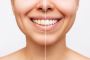 Teeth Whitening: Brighten Your Smile with Confidence