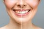 Teeth Whitening/Bleaching Services in Jasper AL