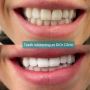 Get Your Brightest Smile with LED Teeth Whitening Treatment 