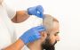 Hair Transplant Cost in India 