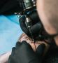 Expert Tattoo Removal in Delhi - Your Path to Clear Skin