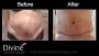 Tummy Tuck (Abdominoplasty) Surgery in Delhi
