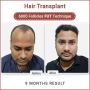 BEST HAIR TRANSPLANT CLINIC, SURGEON IN DELHI