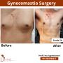 Best Gynecomastia Surgery In India - Procedure & Doctor