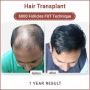 Unshaven Hair Transplant In India